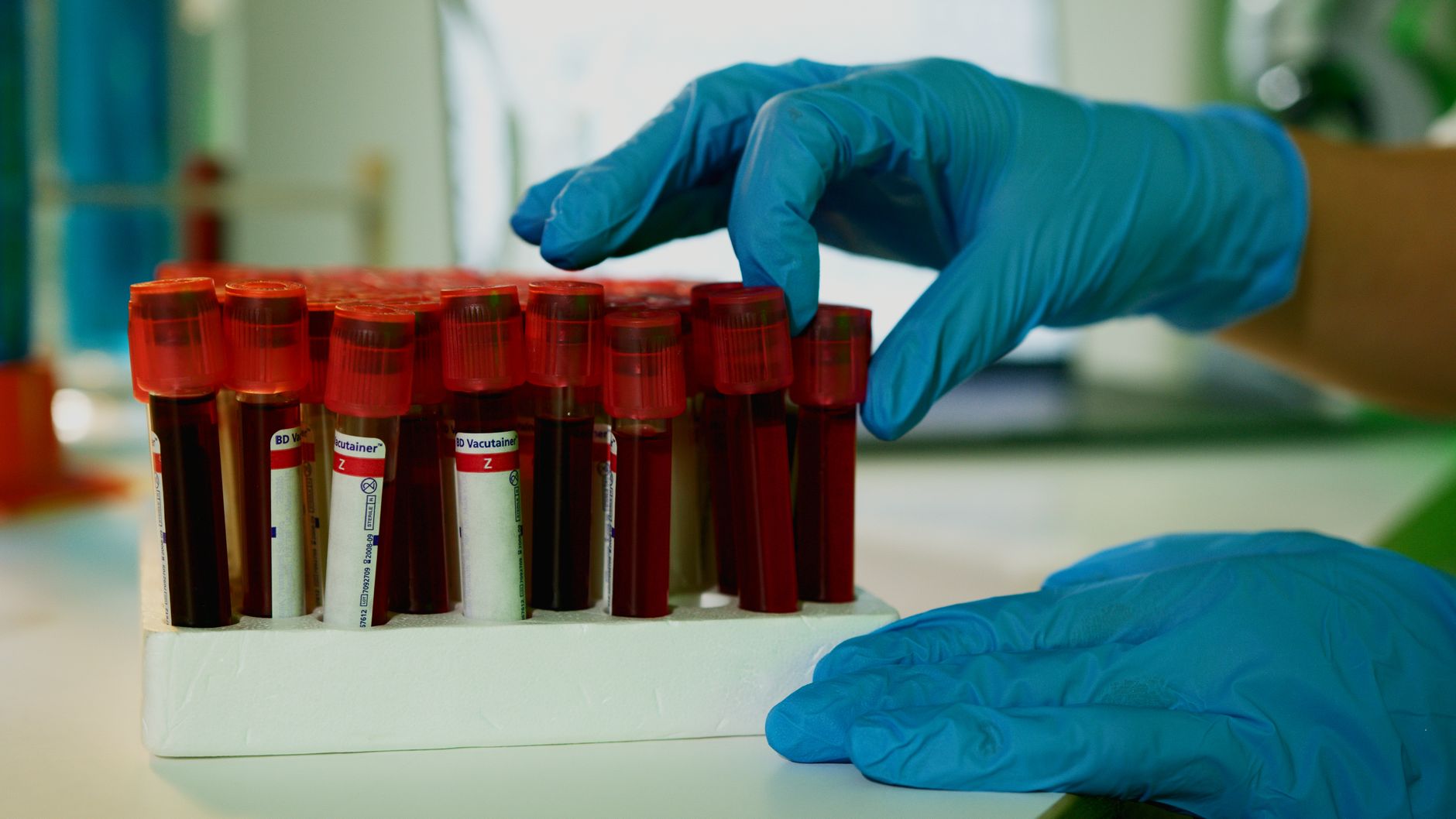laboratory technician pipetting blood serum sample vials